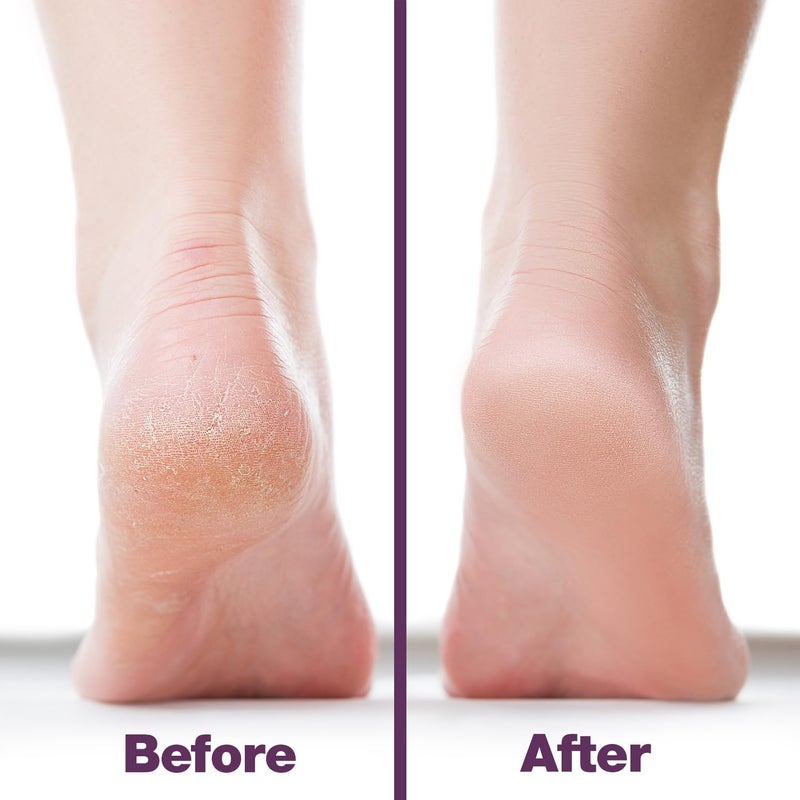 Probelle Double Sided Multidirectional Nickel Foot File Callus Remover - Immediately Reduces calluses and Corns to Powder for Instant Results, Safe Tool (Purple) - Image 4
